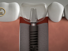 Tiksus implant (İtaliya)