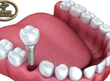 Siscon (Şvesariya) implantı