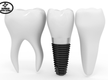 Zimmer implant xidməti