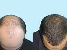 Saç tökülməsinə qarşı vasitə