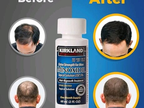 Minoxidil Kirkland 5% losyon 