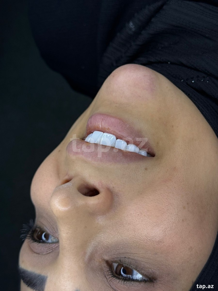 5D zirkoniumları: 1199 AZN — Bakı, Azərbaycan | 46536022 — Tap.Az