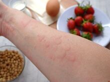 Allergik xəstəliklərin müalicəsi