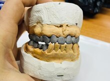 Metalkeramika dişlər
